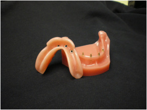 mini implant dentures