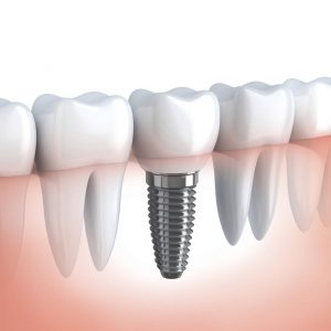 Implant Dentist Pikesville